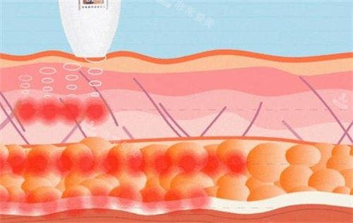 超聲炮儀器作用在皮膚側(cè)剖圖 超聲炮儀器作用在皮膚側(cè)剖圖