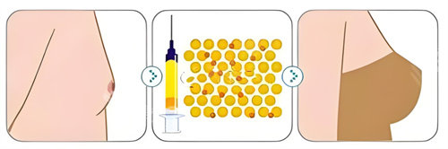 自體脂肪隆胸對(duì)比 自體脂肪隆胸對(duì)比