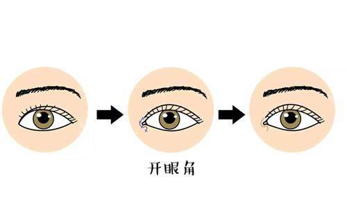 开眼角前后对比漫画图 开眼角前后对比漫画图
