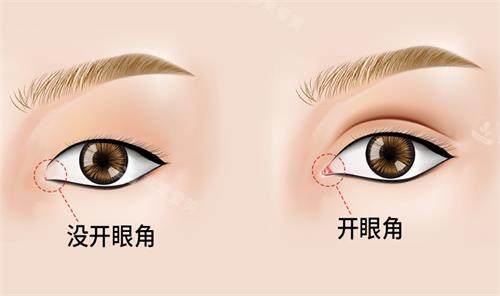 开眼角前后对比图 开眼角前后对比图