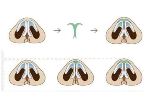 隆鼻流程示意图
