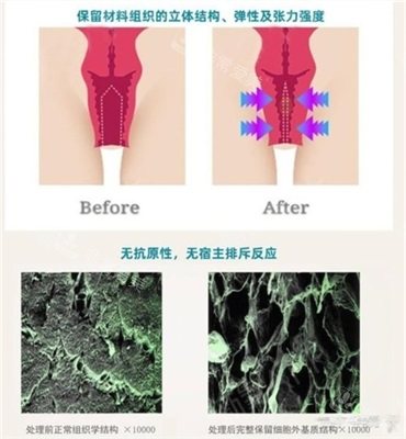 3d生物束带紧缩术前后对比漫画