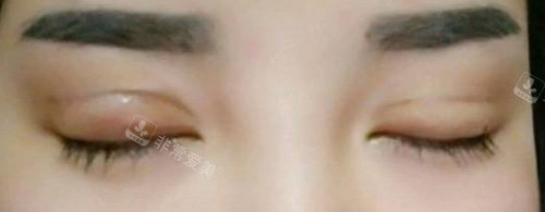 双眼皮失败照片