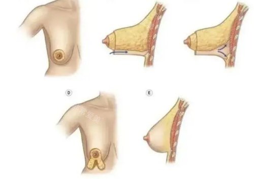 胸部下垂手术示意图