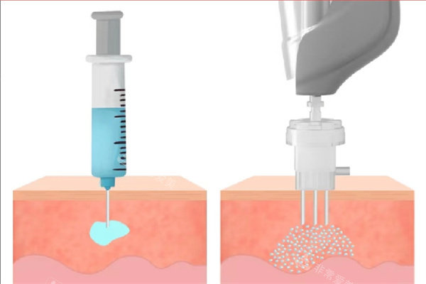 水光针注射方式 水光针注射方式