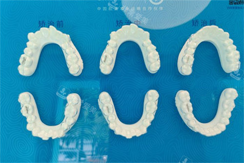 北京美笑口腔牙齿矫正成效对比图