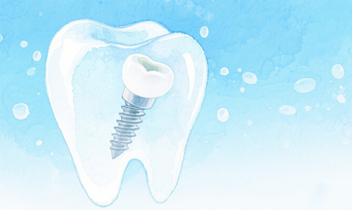 种植牙示意图