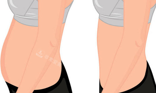 腰腹环吸前后对比图