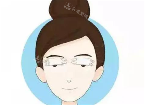 雙眼皮術(shù)后 雙眼皮術(shù)后