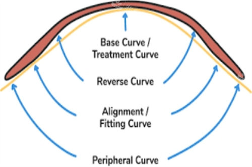 角膜塑形镜作用示意图