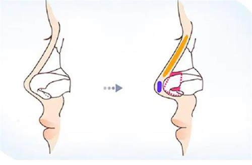 鼻小柱延长前后对比图