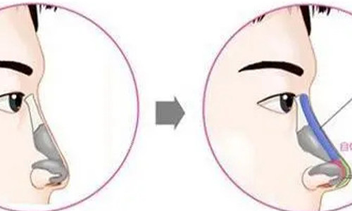 鼻小柱延长的手术示意图