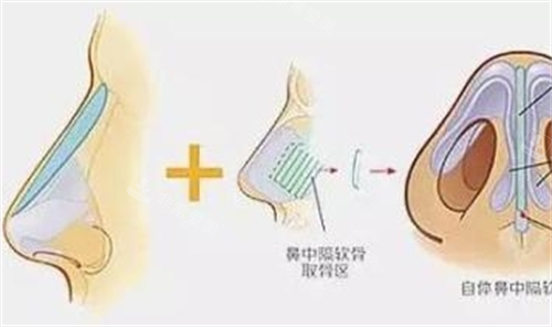 鼻小柱延长手术部位细节动画展示