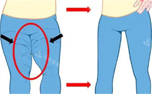 成都蒲小兵院长抽脂怎...