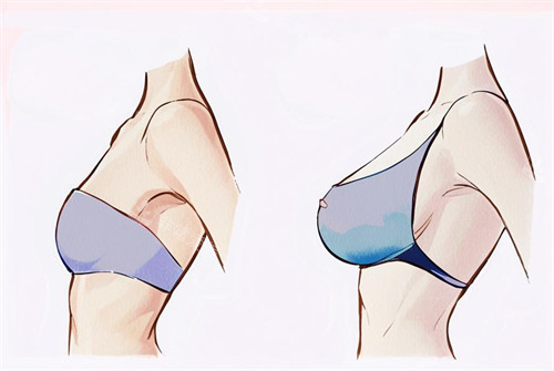 假体隆胸的前后对比图