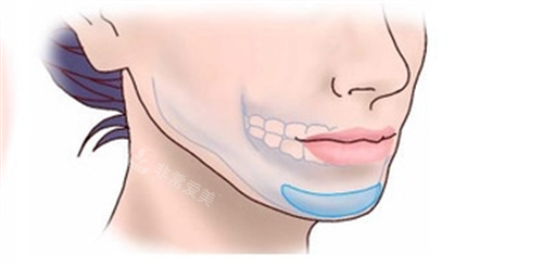 假体垫下巴面部透视图 假体垫下巴面部透视图