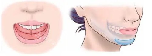 假体垫下巴的位置 假体垫下巴的位置