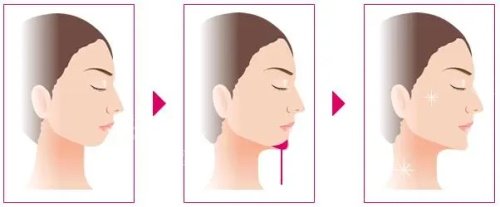 垫下巴的过程图 垫下巴的过程图