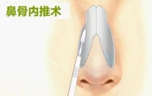 韩国鼻骨内推多少钱?我在韩国鼻骨内推价格165万韩币,价格不贵但医生技术好！
