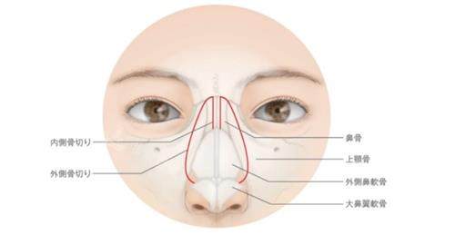 鼻骨内推的部位