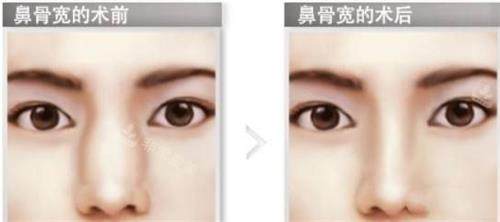 鼻骨内推前后的对比