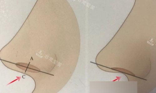 需要进行鼻小柱延长手术的情况