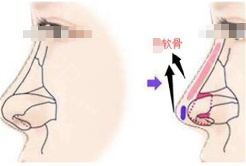 鼻小柱垫软骨侧面透视图