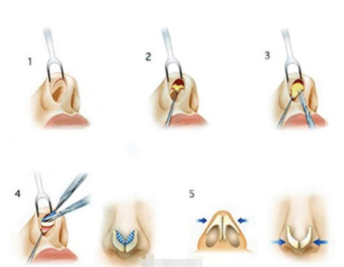 鼻小柱延长手术过程展示图