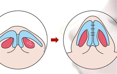 鼻小柱延长前后清晰对比图