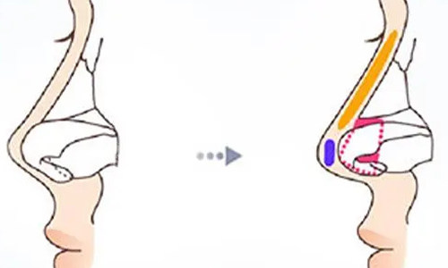 鼻小柱延长的前后对比图