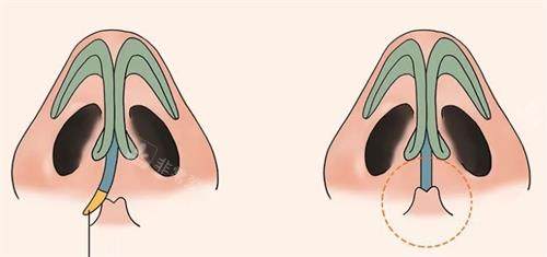 鼻中隔偏曲手术后的成效