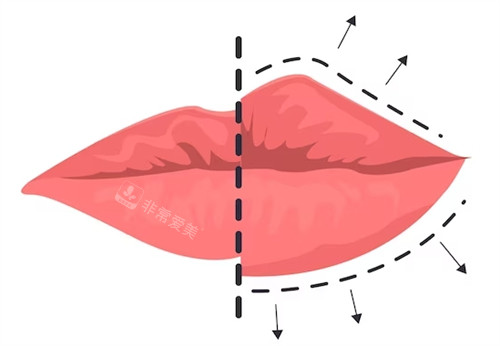 丰唇手术对比图 丰唇手术对比图