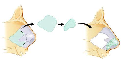 超体隆鼻流程图