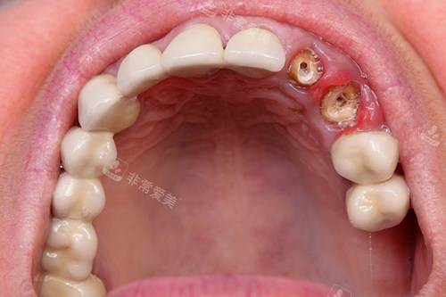 牙齿龋坏钻洞实拍