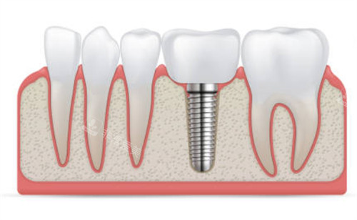 种植牙和临牙示意图