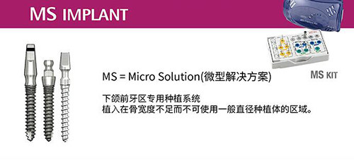 奥齿泰种植牙MS系列
