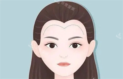 植发际线卡通 植发际线卡通