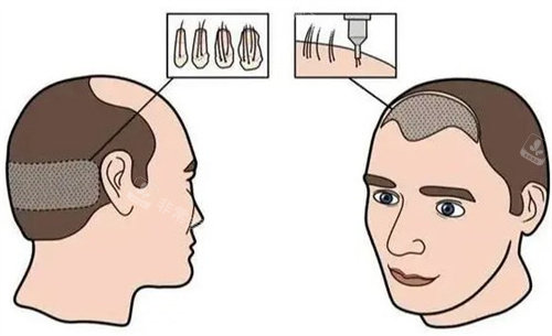 发际线植发 发际线植发