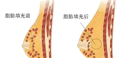 自体脂肪隆胸脂肪对比 自体脂肪隆胸脂肪对比