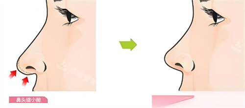 鼻头缩小前后对比