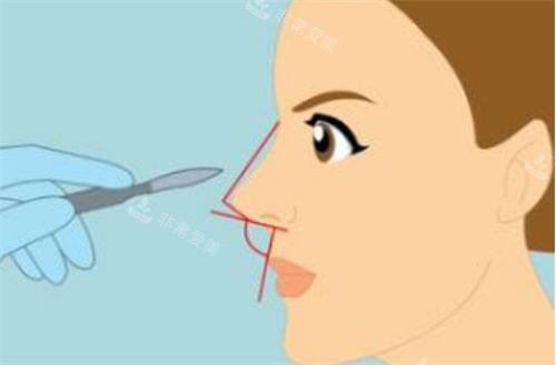 鼻部角度展示图图