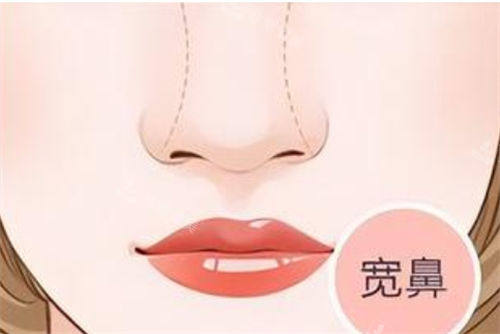 宽鼻形态展示图