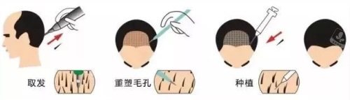 植发过程图 植发过程图