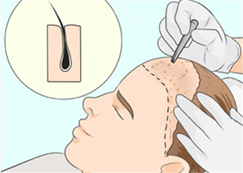 微针植发过程图解 微针植发过程图解