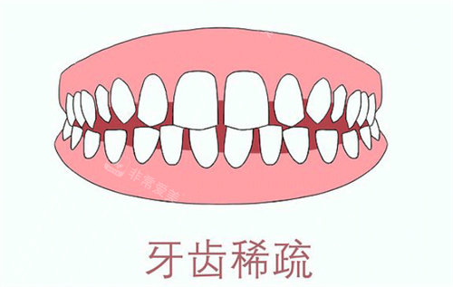 牙齿稀疏卡通示意图