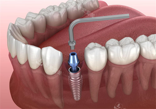 种植牙操作动画图片
