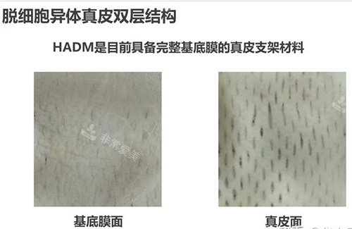 3d生物束带紧缩术材料结构示意图