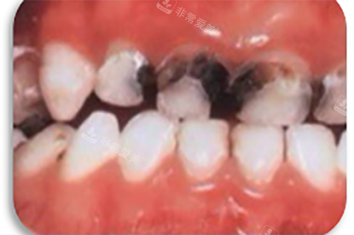 牙根龋坏图片 