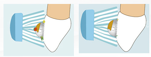 牙齿矫正OBrace球面托槽清洁侧面图