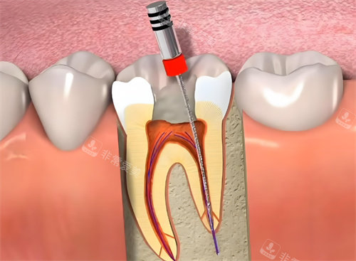 根管治疗动画展示